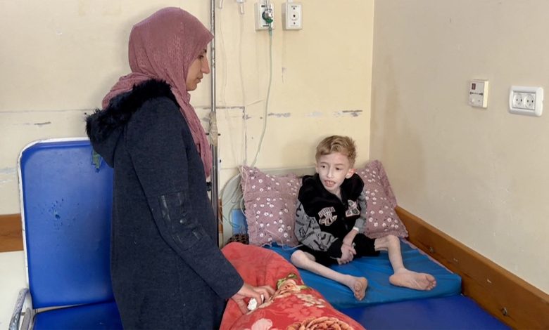 صحف عالمية: أطفال غزة مهددون بمشاكل صحية مزمنة بسبب سوء التغذية